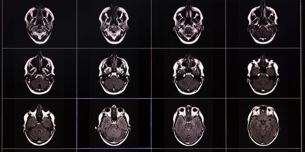 Massive Neuroscience Study Reveals Why Older Brains are Susceptible to Memory Loss