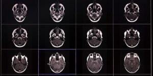 Massive Neuroscience Study Reveals Why Older Brains are Susceptible to Memory Loss